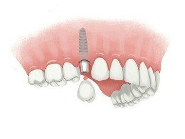 انواع ایمپلنت دندان و روش نگهداری از انها  چیست؟