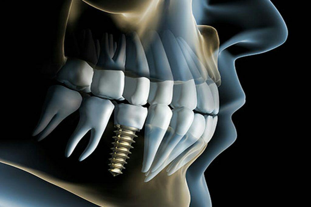 چرا ایمپلنت بهتر از دیگر روش های درمان بی دندانی است؟