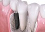 ایمپلنت دندانی چیست