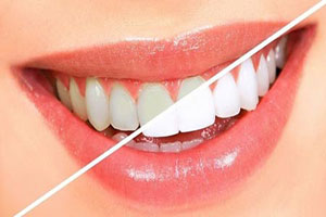  علت بدرنگ شدن دندان‌ها