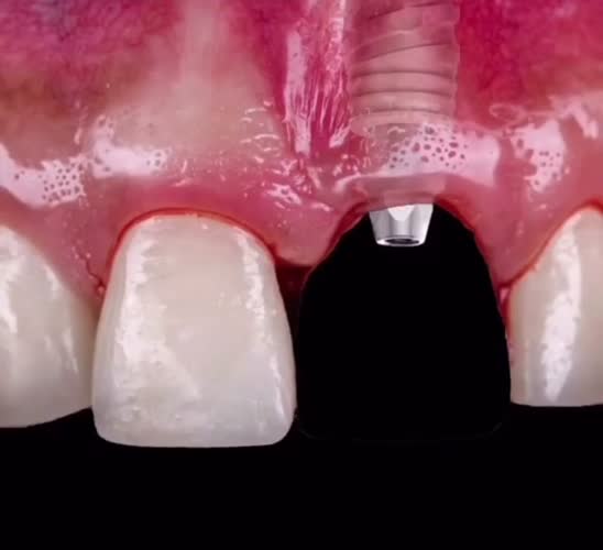 ساختار ایمپلنت در دهان