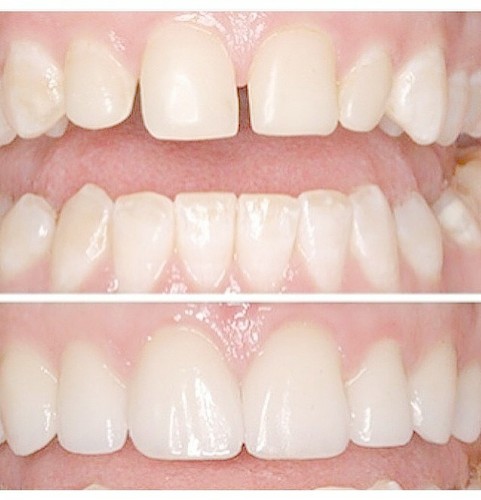 تصاویر لمینیت دندان