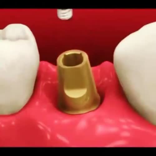 کاشت دندان و ایمپلنت های دندانی